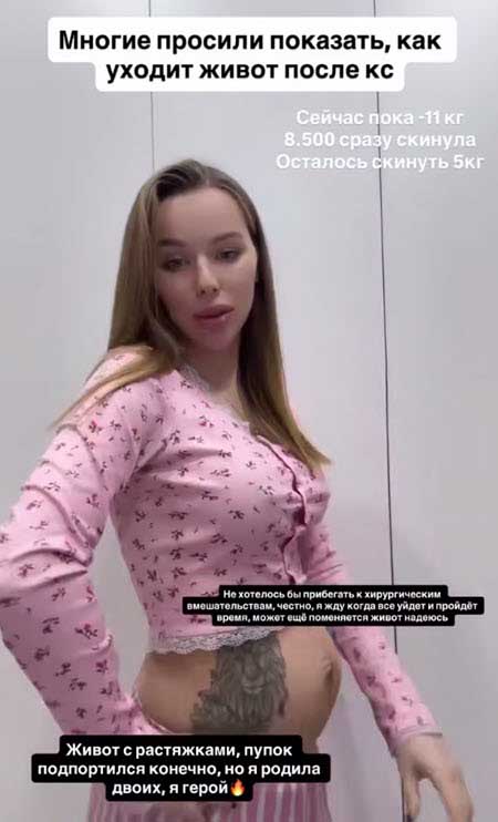 Таня Репина планирует пластику живота после двух беременностей