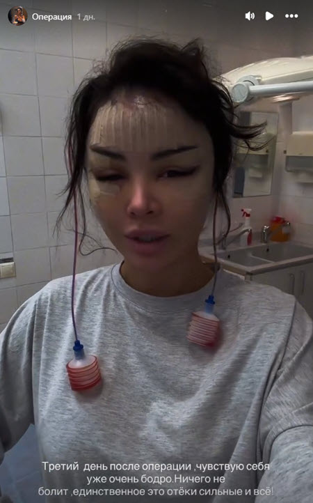 Яна Шафеева и Яна Захарова выглядят после пластики, как персонажи фильма ужасов