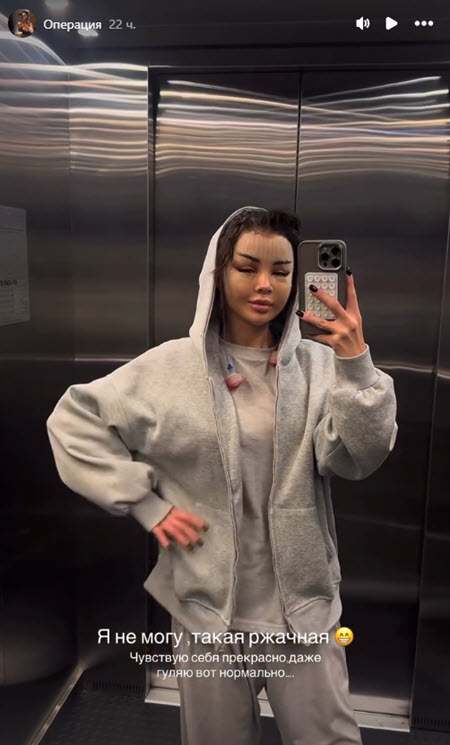 Яна Шафеева и Яна Захарова выглядят после пластики, как персонажи фильма ужасов