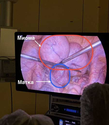 Надежду Ермакову прооперировали