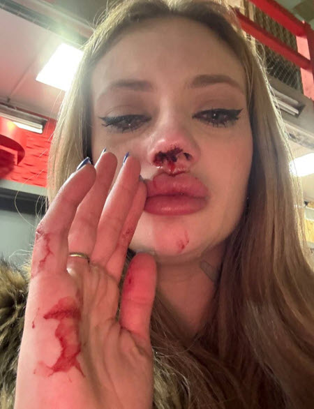 Ксюшу Карпову кто-то жестко ударил по лицу и разбил ей нос