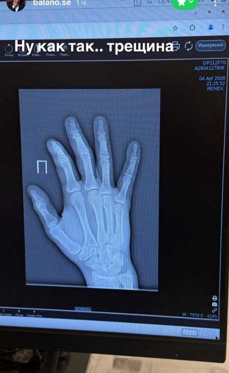 Владимир Балан получил травму